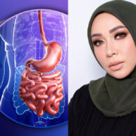 Bariatrik, Operasi Penurunan Berat Badan Seperti yang Dijalani Melly Goeslaw